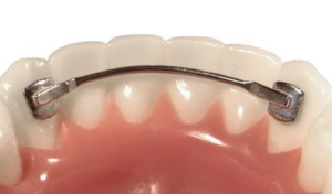 Contentie Linguala Colabila Prefabricata Bara Lower/Upper 3-3 2bucati 3B 
