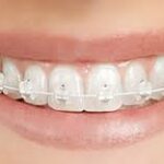 Arcuri Fizionomice NiTi Super Elastic Oval 1 arc/pachet 3B